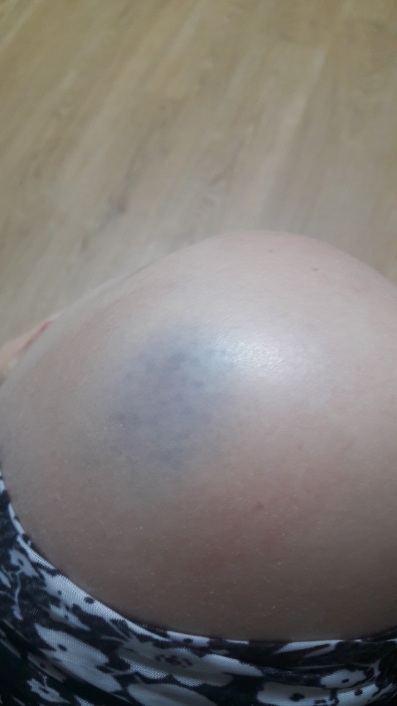 무릎에 멍 들어서 아포...8.8 | 인스티즈