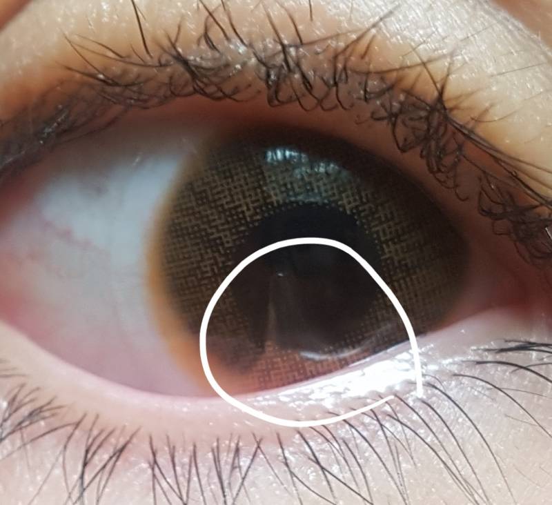 나 렌즈 낄 때 렌즈가 이렇게 안펴지는데 얇아서그런거야? | 인스티즈
