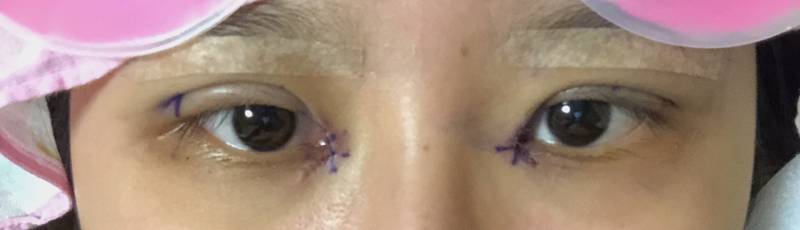 쌍수 방금 하고 왔는데 라인 어때? ㅎㅇㅈㅇ | 인스티즈