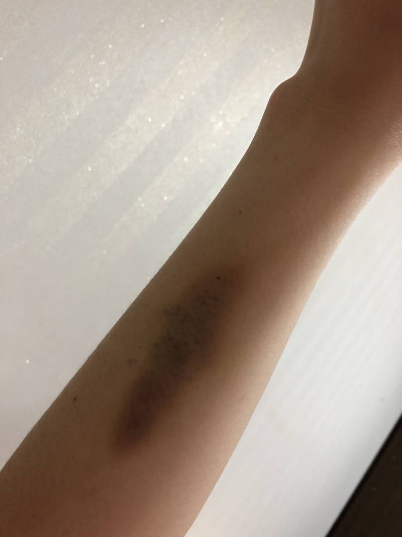 혹시 주사맞으면 멍 엄청 심하게 드는 익 있어..? | 인스티즈