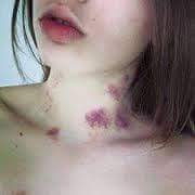 크리스마스에 걸린다는 피부병... | 인스티즈