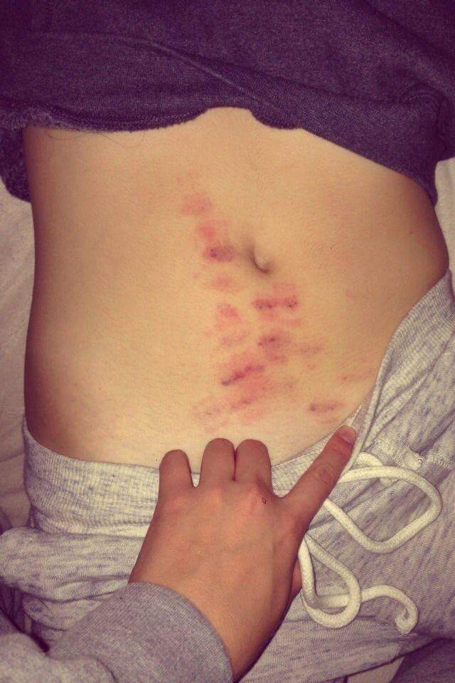 크리스마스에 걸린다는 피부병... | 인스티즈