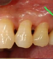 스케일링을 꼭 해야하는 이유(혐오주의) | 인스티즈